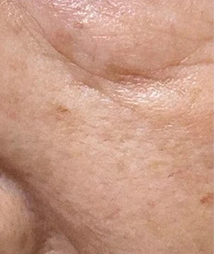 Close-up skin, case 01, 14-day internal trial