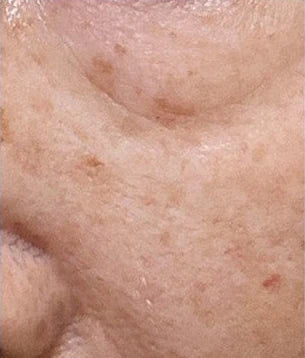 Close-up skin, case 02, 14-day internal trial
