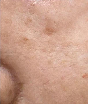Close-up skin, case 03, 14-day internal trial