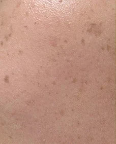 Close-up skin, case 01, 14-day internal trial