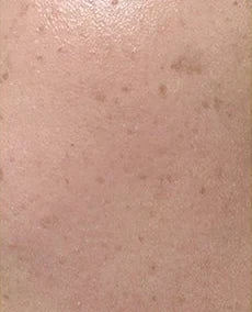 Close-up skin, case 02, 14-day internal trial