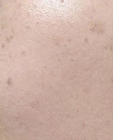 Close-up skin, case 03, 14-day internal trial