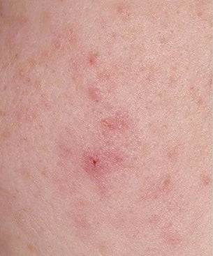 Close-up skin, case 01, 7-day internal trial