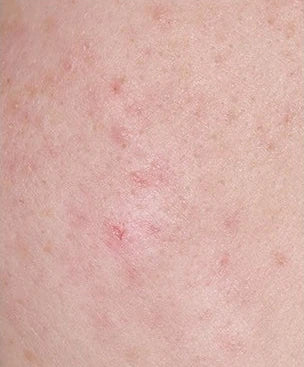 Close-up skin, case 02, 7-day internal trial