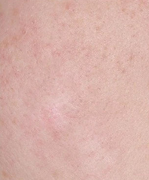 Close-up skin, case 03, 7-day internal trial